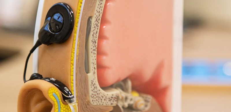 Hörimplantate Cochlea-Implantate Service Partner Bayreuth